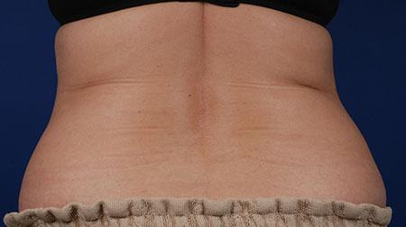 CoolSculpting result at Marcus Medical in Los Angeles, CA