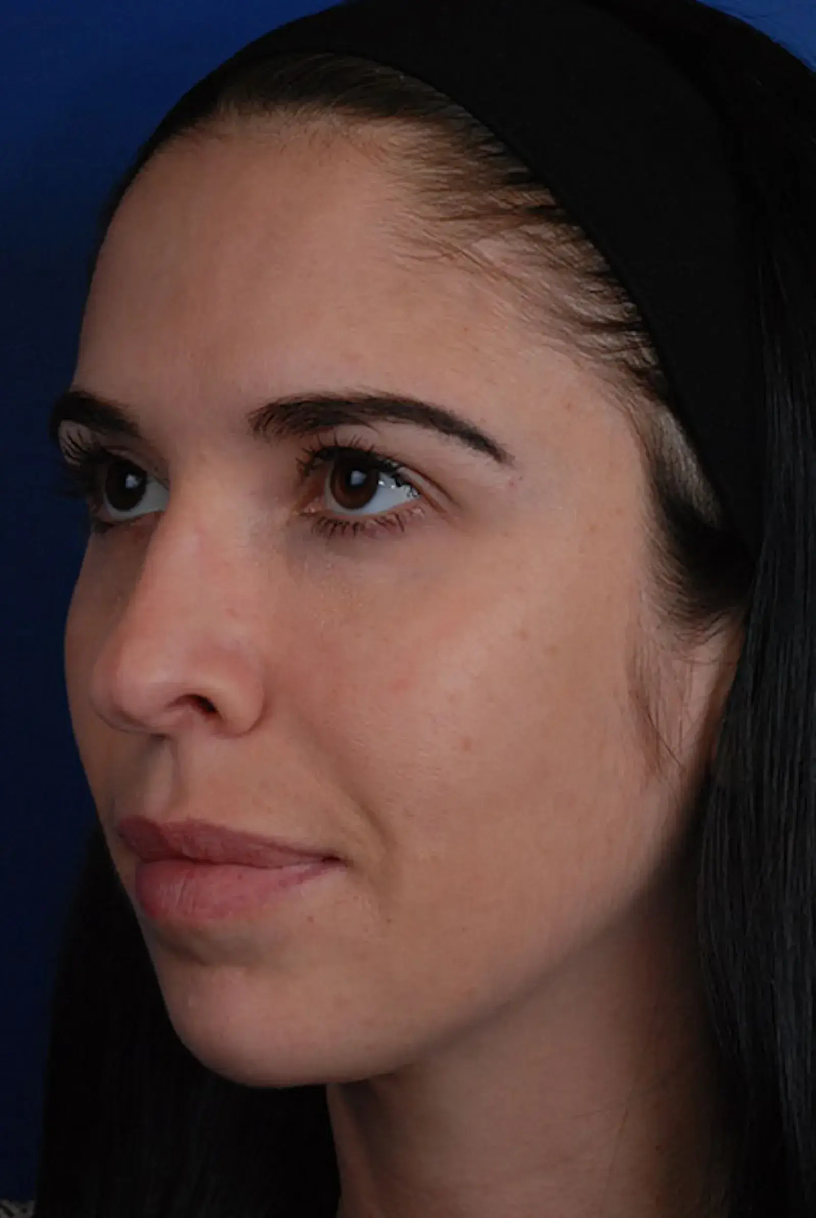 Marcus Medical jawline filler after — Redondo Beach, CA