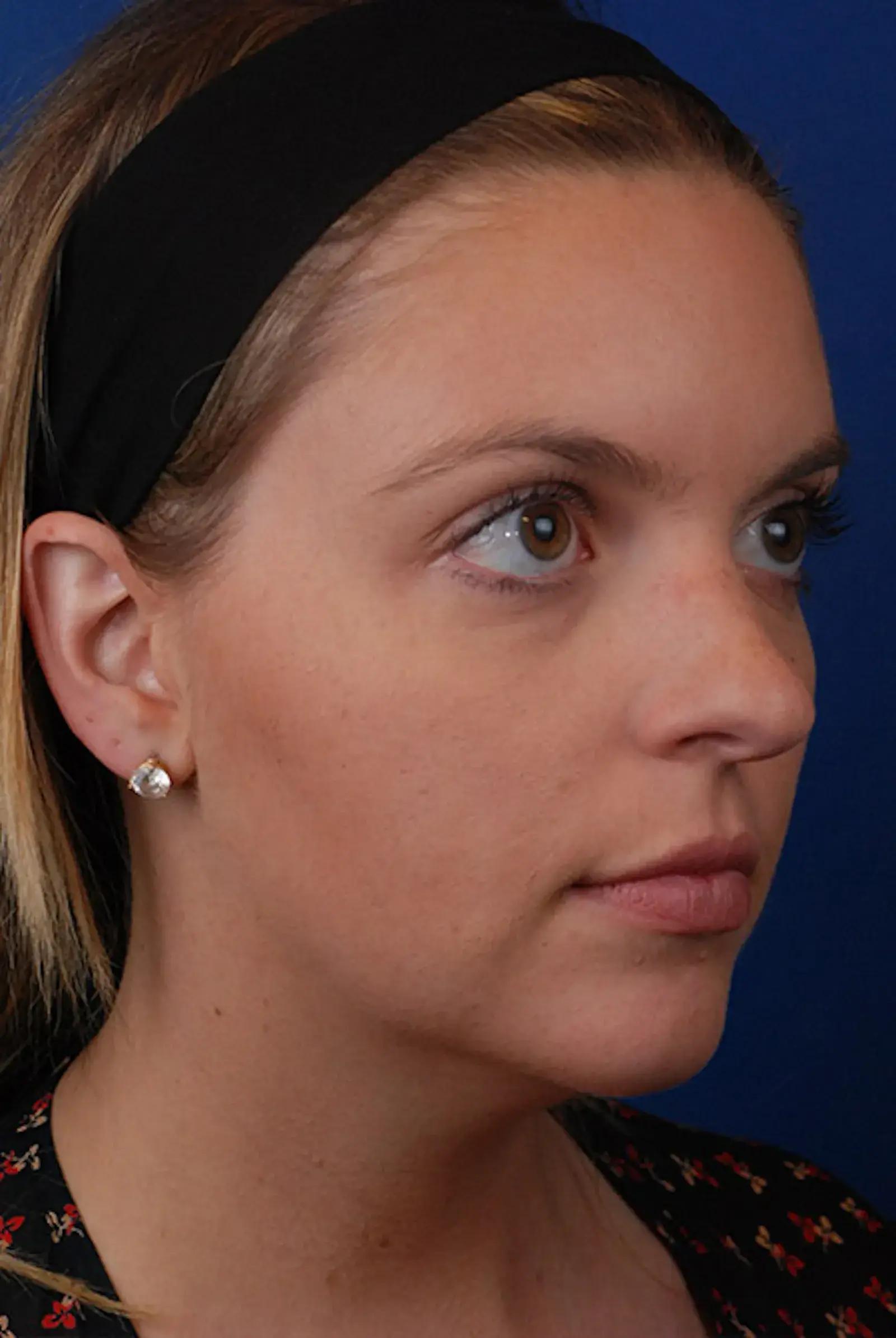 Marcus Medical jawline filler after — Redondo Beach, CA