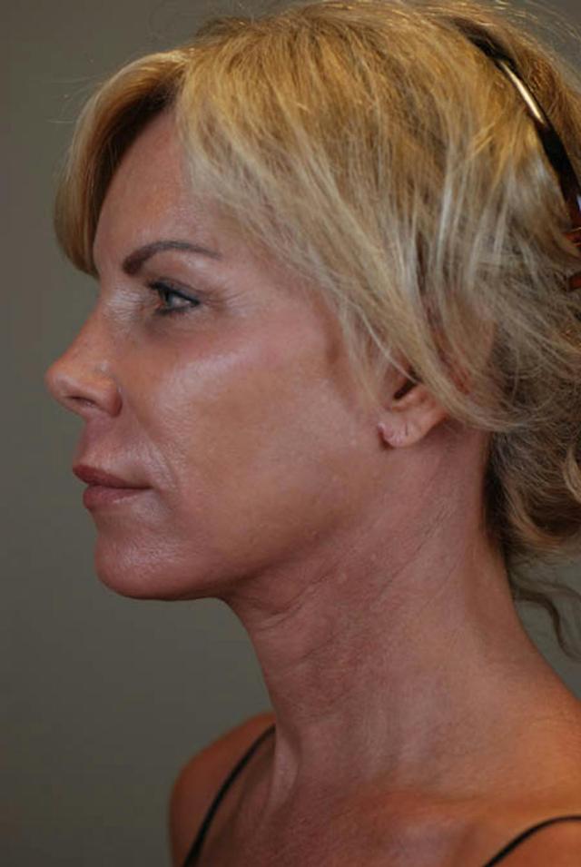 Neck Lift after at Marcus Medical in Los Angeles, CA