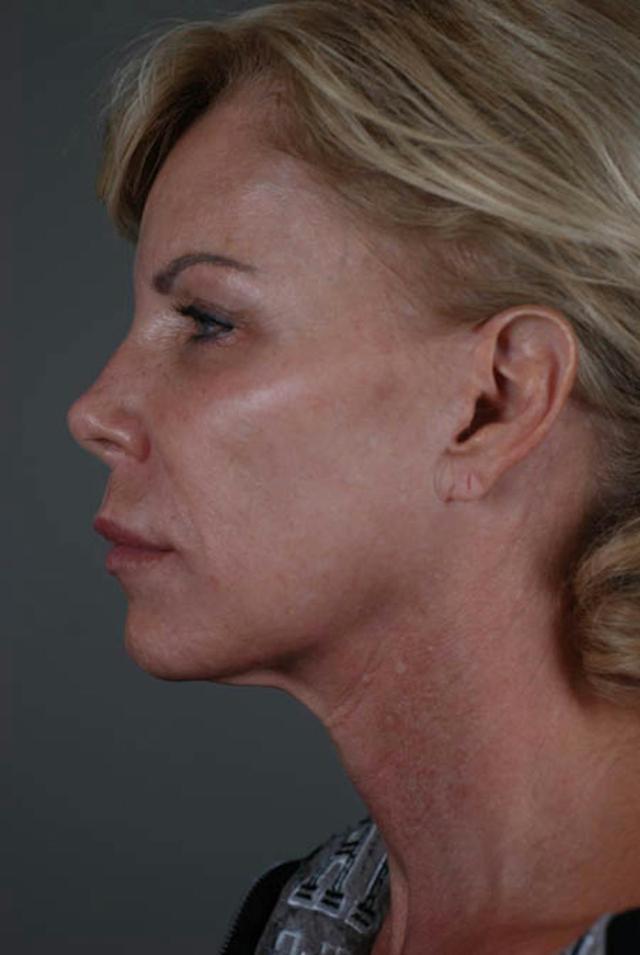 Neck Lift before at Marcus Medical in Los Angeles, CA