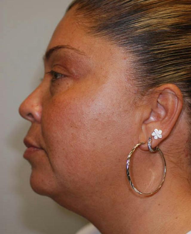 Liposuction before at Marcus Medical in Los Angeles, CA