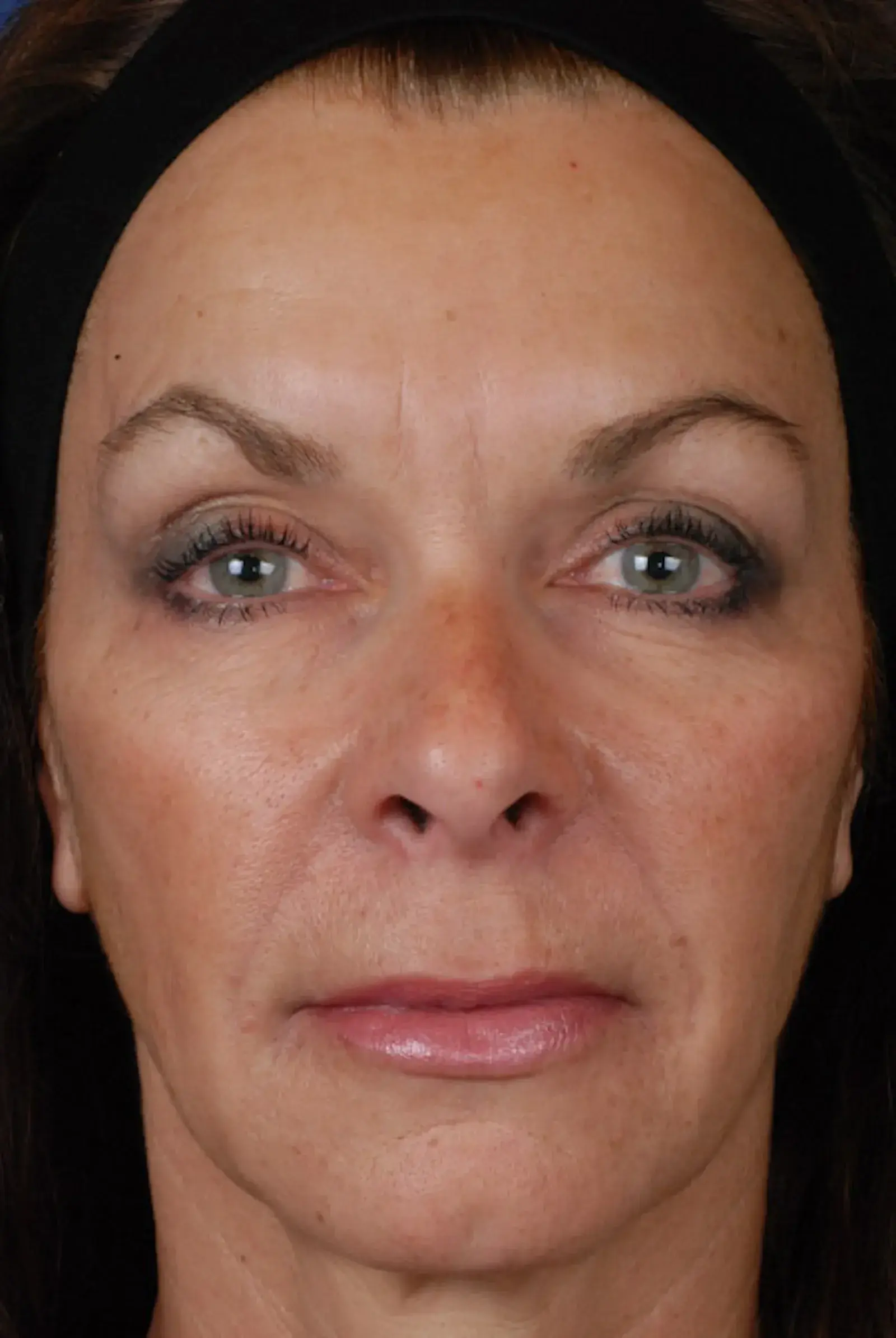 Marcus Medical cheek filler after — Redondo Beach, CA