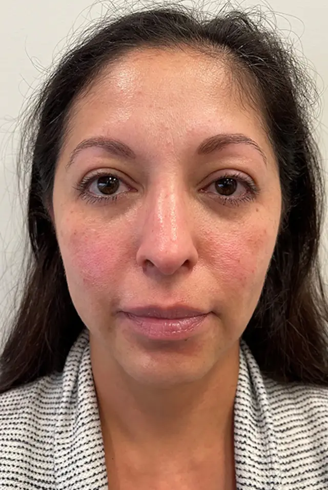 Juvederm before at Marcus Medical in Redondo Beach, CA