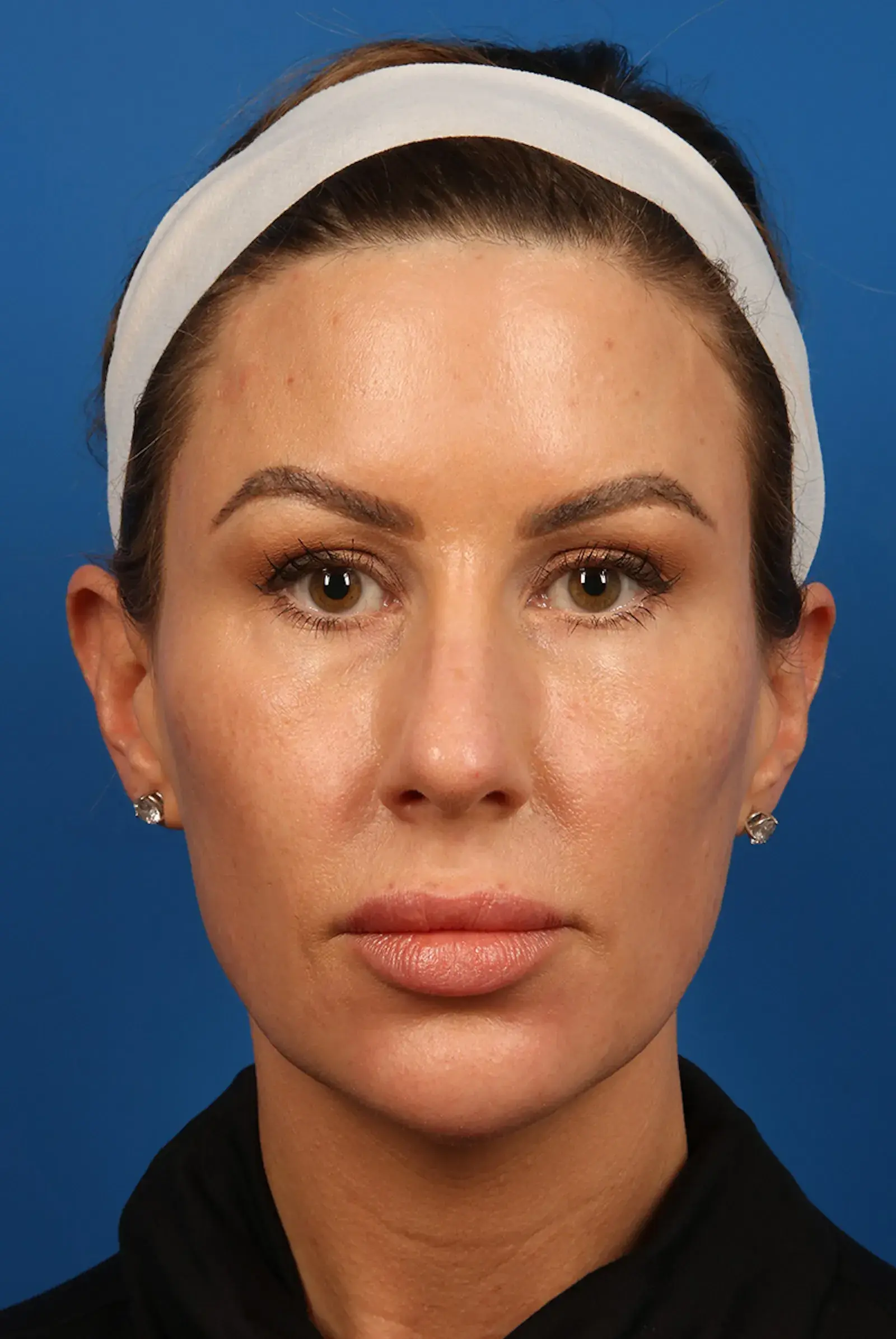 Marcus Medical jawline filler after — Redondo Beach, CA
