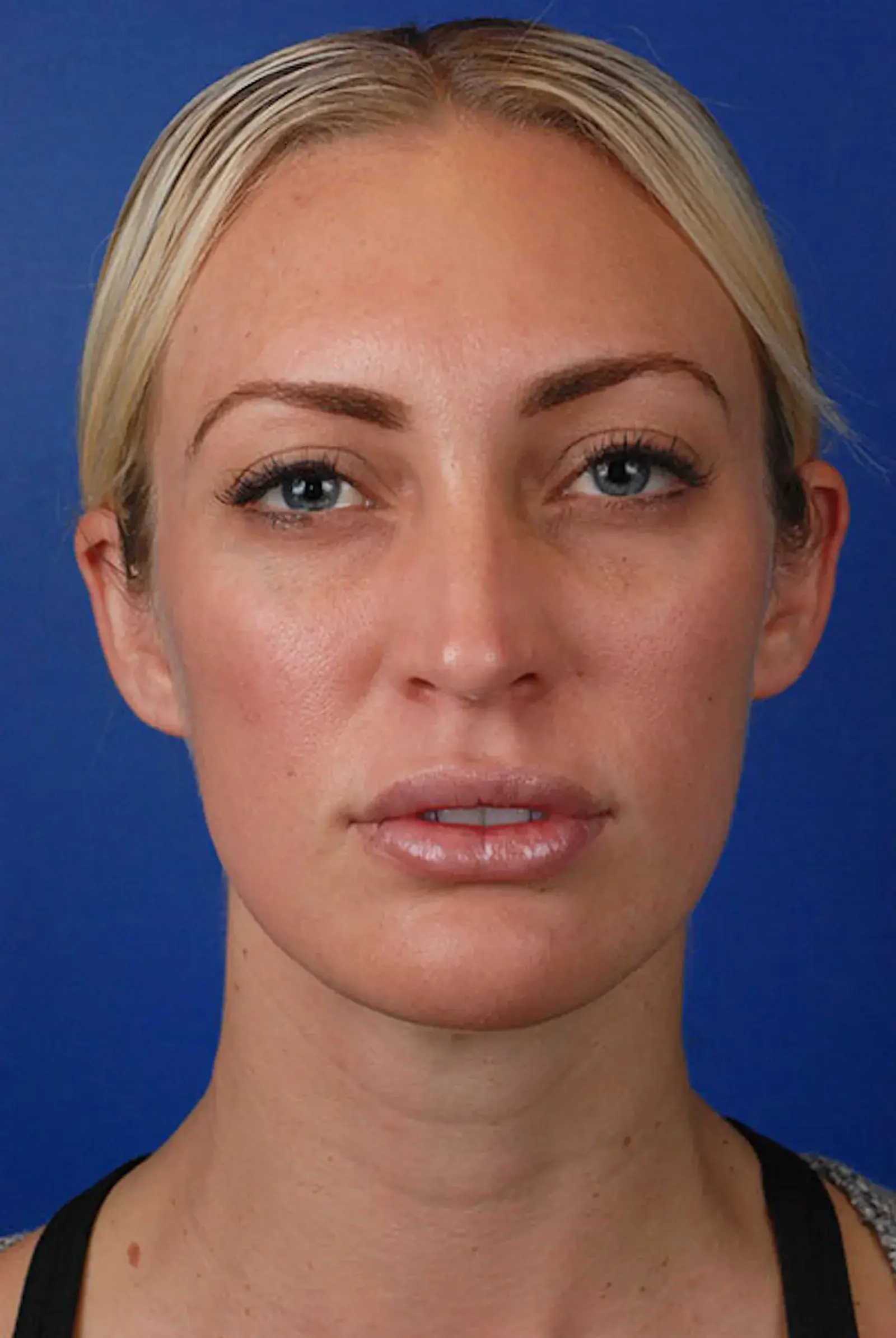 Marcus Medical cheek filler after — Redondo Beach, CA
