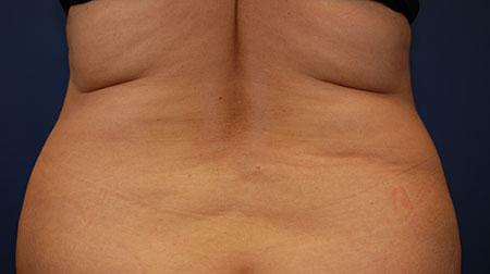 CoolSculpting result at Marcus Medical in Los Angeles, CA