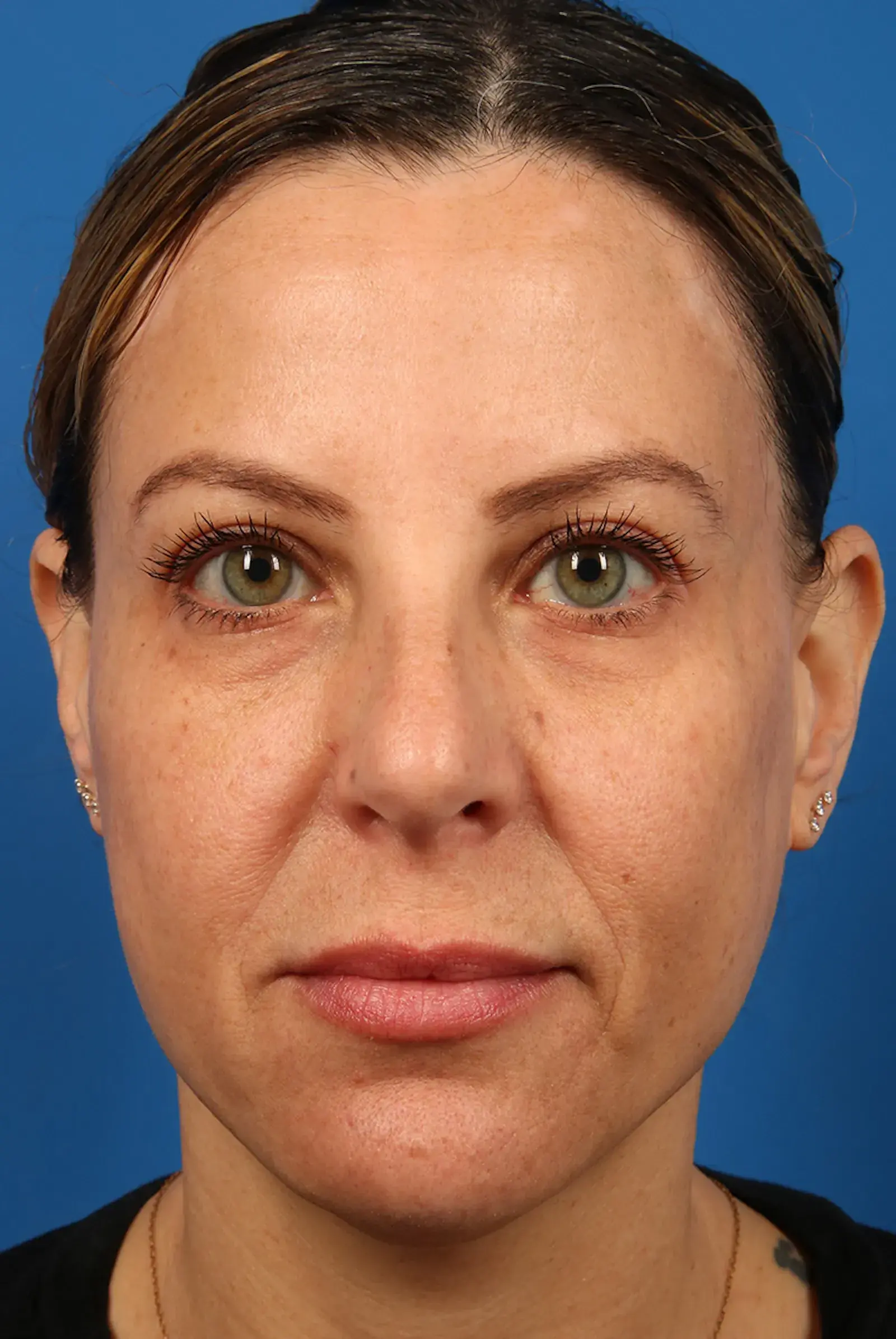 Marcus Medical cheek filler after — Redondo Beach, CA
