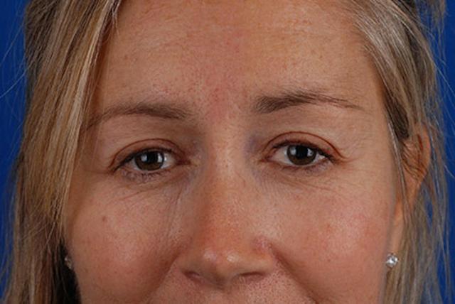Brow Lift after at Marcus Medical in Los Angeles, CA