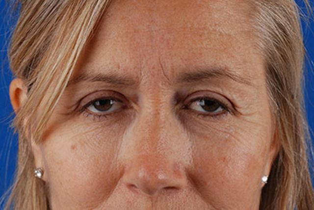 Brow Lift before at Marcus Medical in Los Angeles, CA