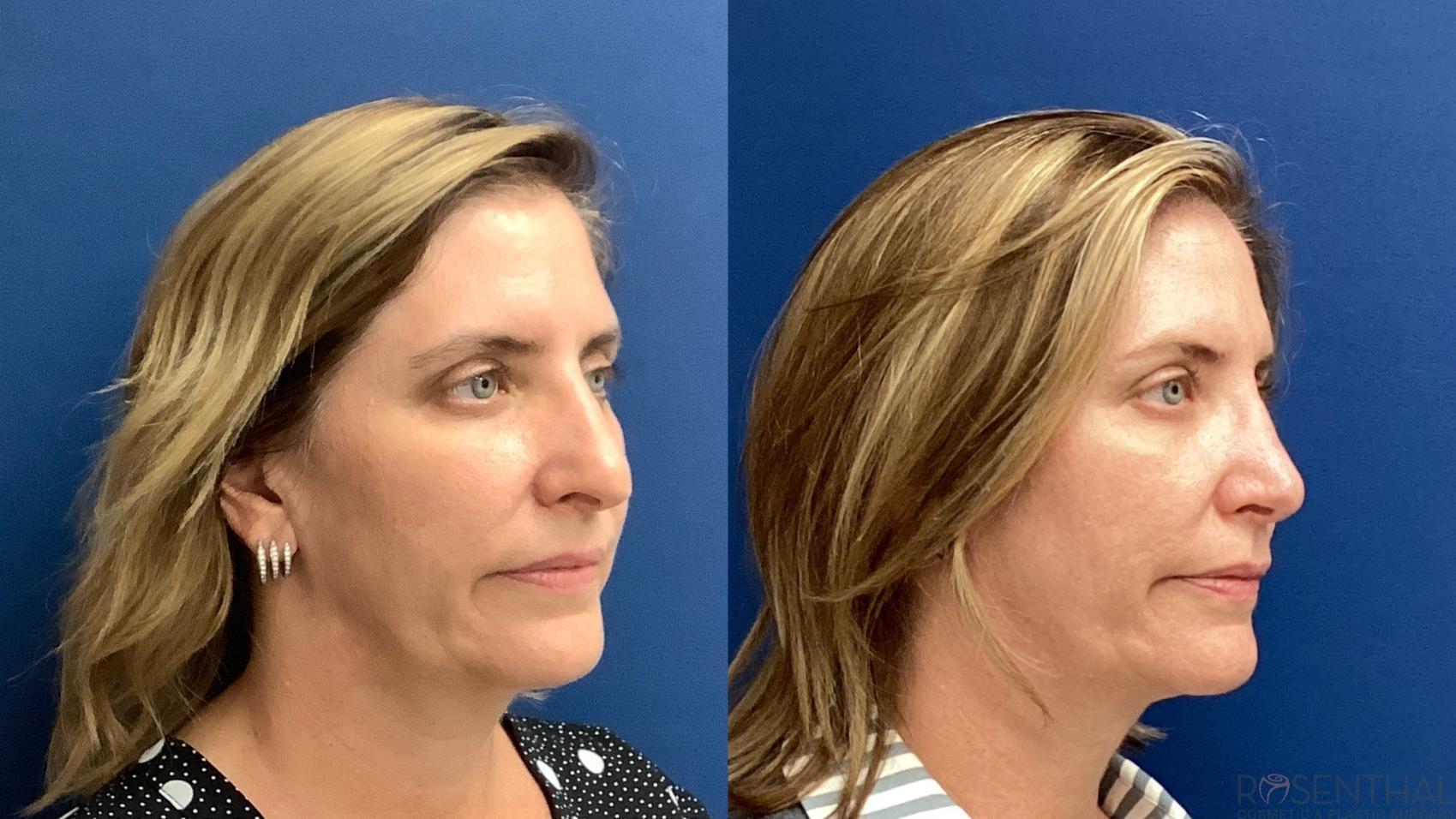 Rosenthal Cosmetic & Plastic Surgery rhinoplasty result — Boynton Beach, FL