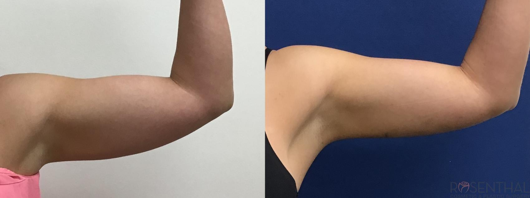 Rosenthal Cosmetic & Plastic Surgery liposuction result — Boynton Beach, FL