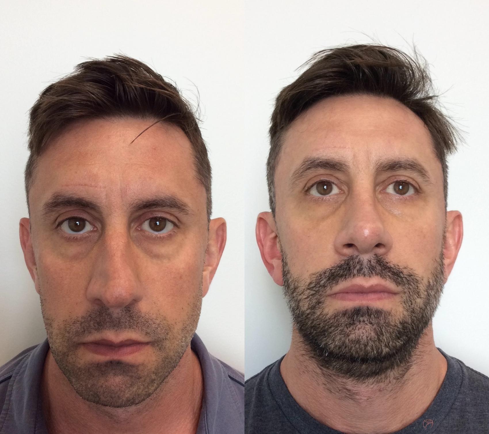 Rosenthal Cosmetic & Plastic Surgery rhinoplasty result — Boynton Beach, FL