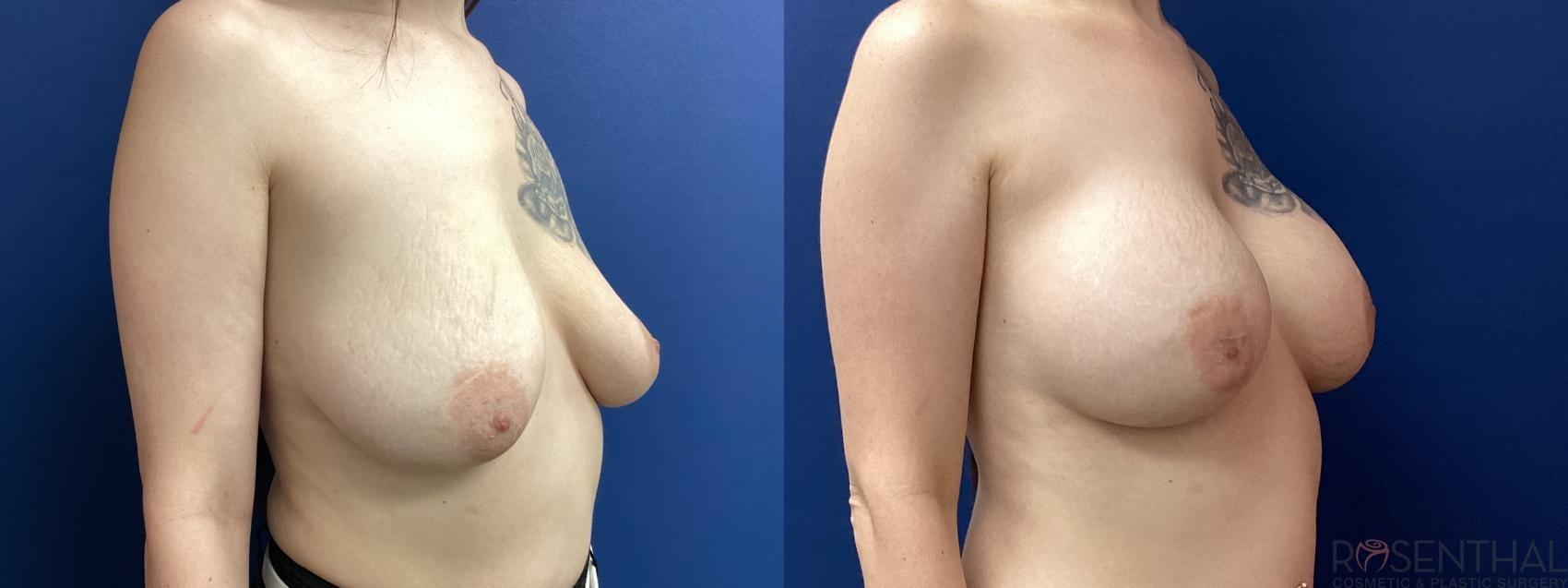 Rosenthal Cosmetic & Plastic Surgery breast augmentation result — Boynton Beach, FL