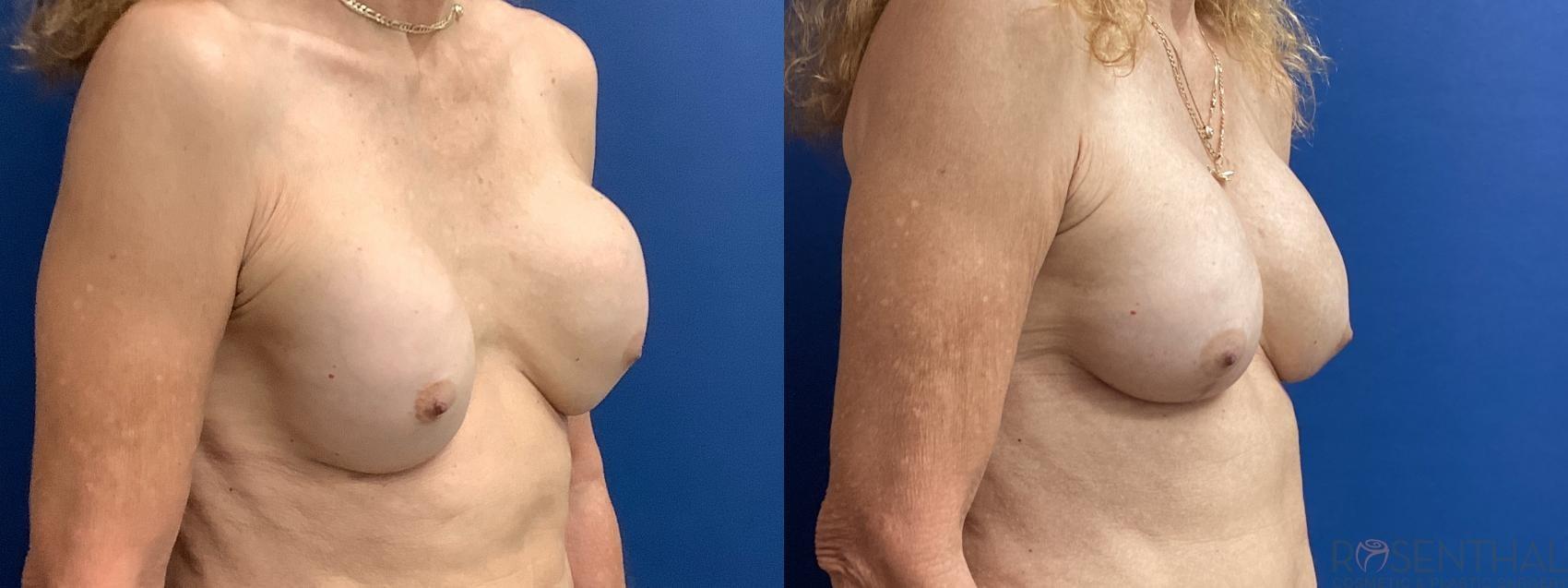 Rosenthal Cosmetic & Plastic Surgery breast augmentation revision result — Boynton Beach, FL