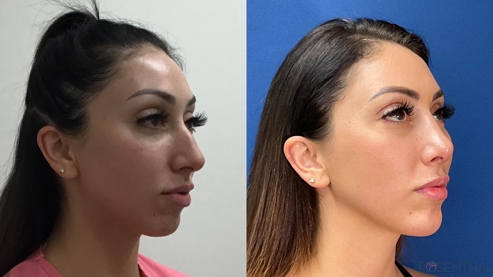 Rosenthal Cosmetic & Plastic Surgery rhinoplasty result — Boynton Beach, FL