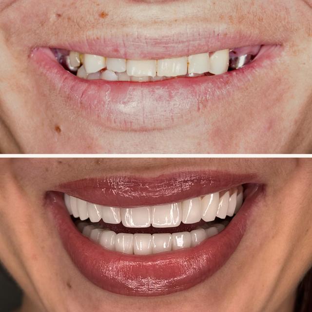 Dental Implants result at Elite Smiles by Walter Meden DDS in Draper, UT