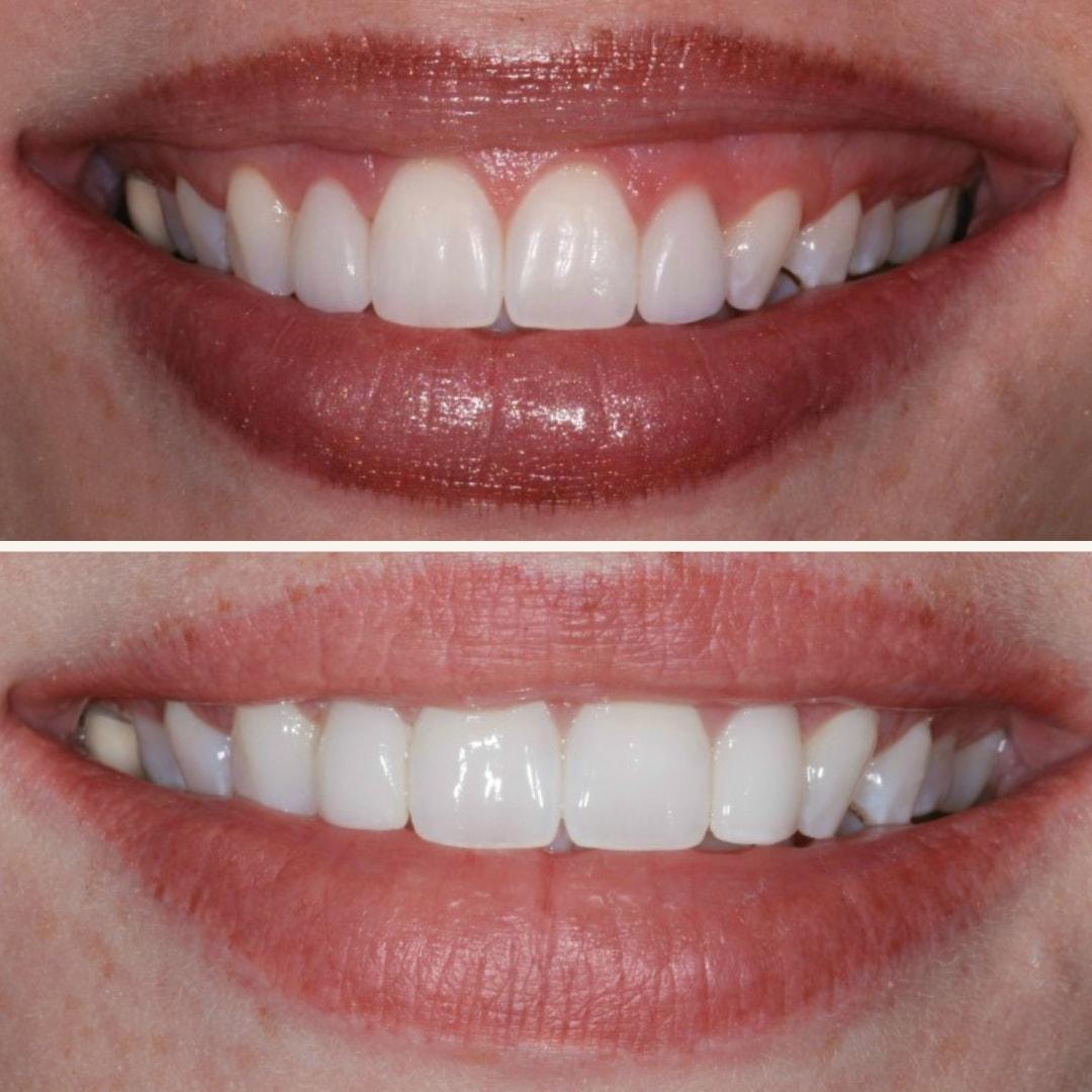 Elite Smiles by Walter Meden DDS veneers result — Draper, UT