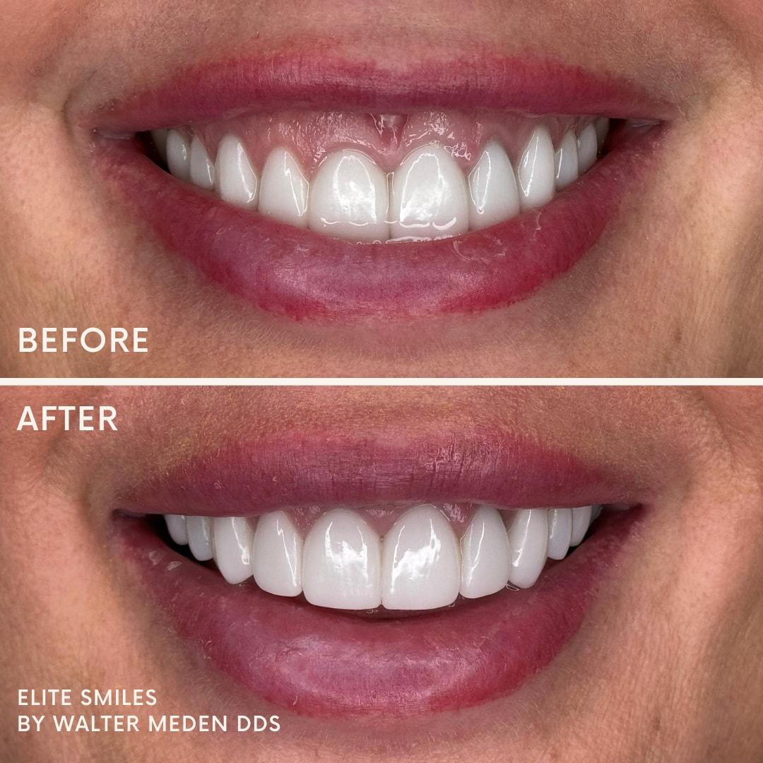 Elite Smiles by Walter Meden DDS veneers result — Draper, UT