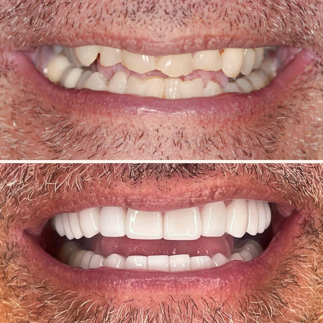 Elite Smiles by Walter Meden DDS veneers result — Draper, UT
