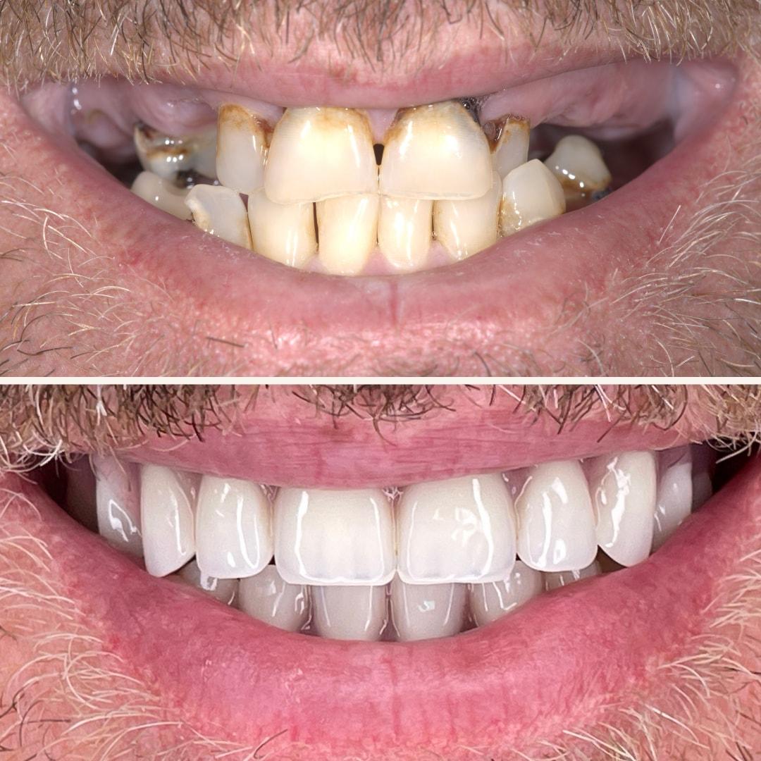 Elite Smiles by Walter Meden DDS smile makeover result — Draper, UT