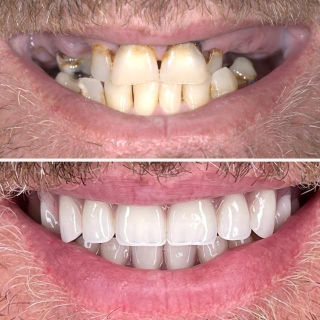 Smile Makeover result at Elite Smiles by Walter Meden DDS in Draper, UT