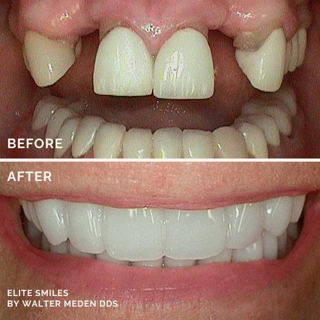 Dental Implants result at Elite Smiles by Walter Meden DDS in Draper, UT