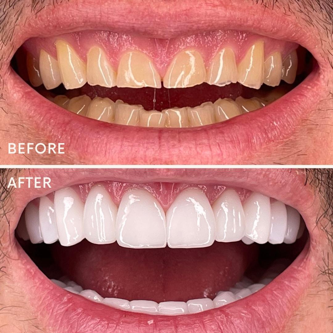 Elite Smiles by Walter Meden DDS veneers result — Draper, UT