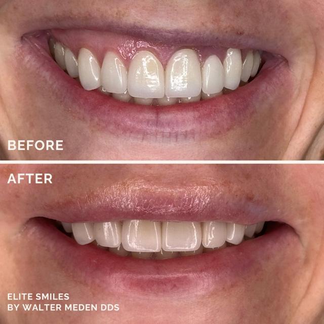 Gum Contouring result at Elite Smiles by Walter Meden DDS in Draper, UT