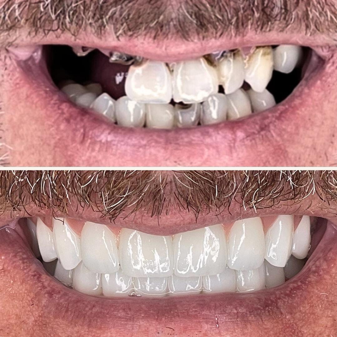 Elite Smiles by Walter Meden DDS smile makeover result — Draper, UT