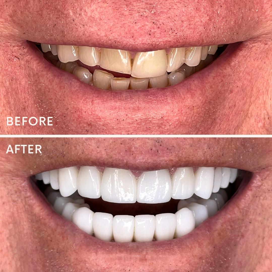 Elite Smiles by Walter Meden DDS veneers result — Draper, UT