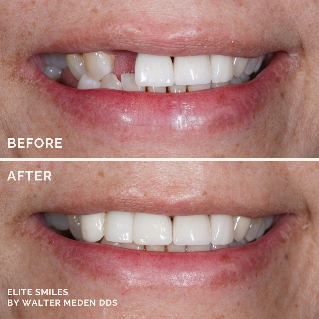 Elite Smiles by Walter Meden DDS dental implants result — Draper, UT