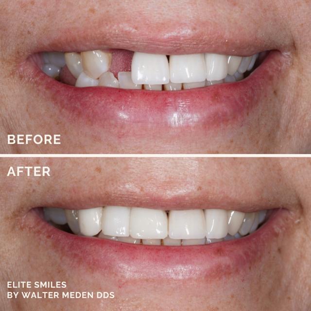 Dental Implants result at Elite Smiles by Walter Meden DDS in Draper, UT