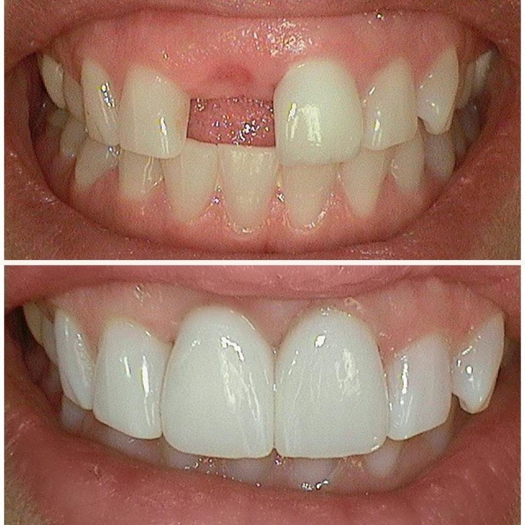 Elite Smiles by Walter Meden DDS dental implants result — Draper, UT