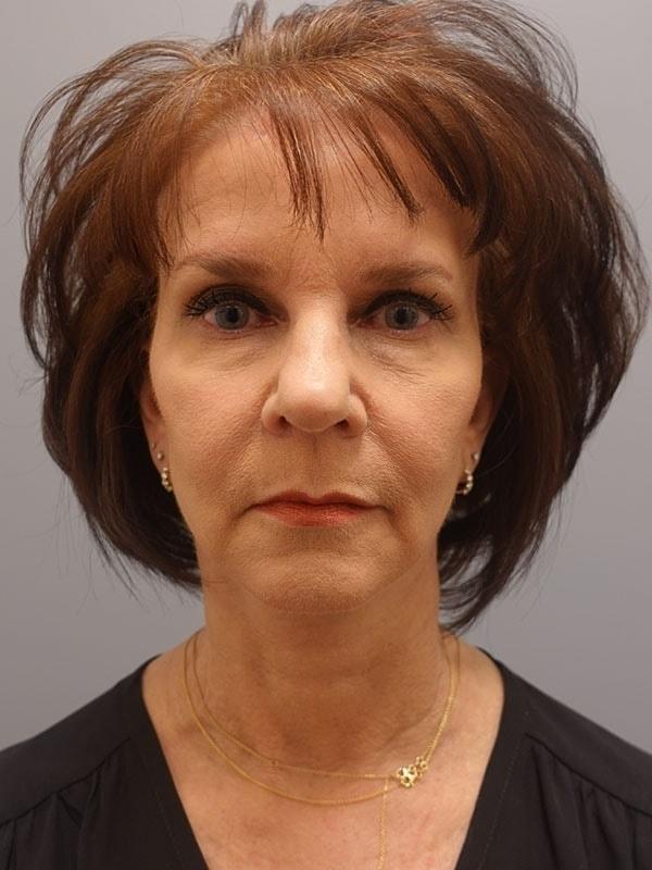 Evelina Plastic Surgery and Aesthetics (Katherine B. Santosa, MD) facelift after — Atlanta, GA