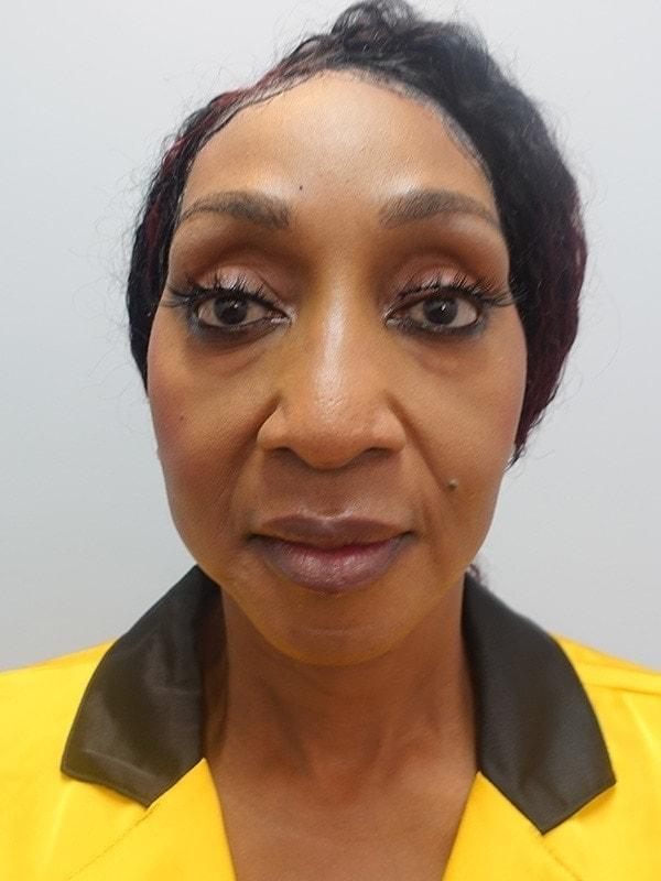 Evelina Plastic Surgery and Aesthetics (Katherine B. Santosa, MD) facelift after — Atlanta, GA