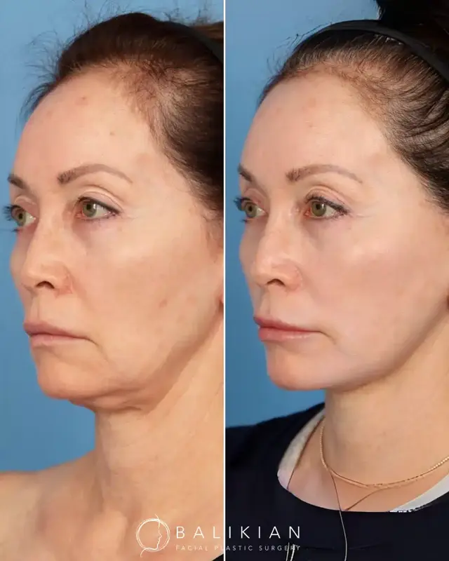 Facelift result at Balikian Facial Plastic Surgery in Del Mar, CA