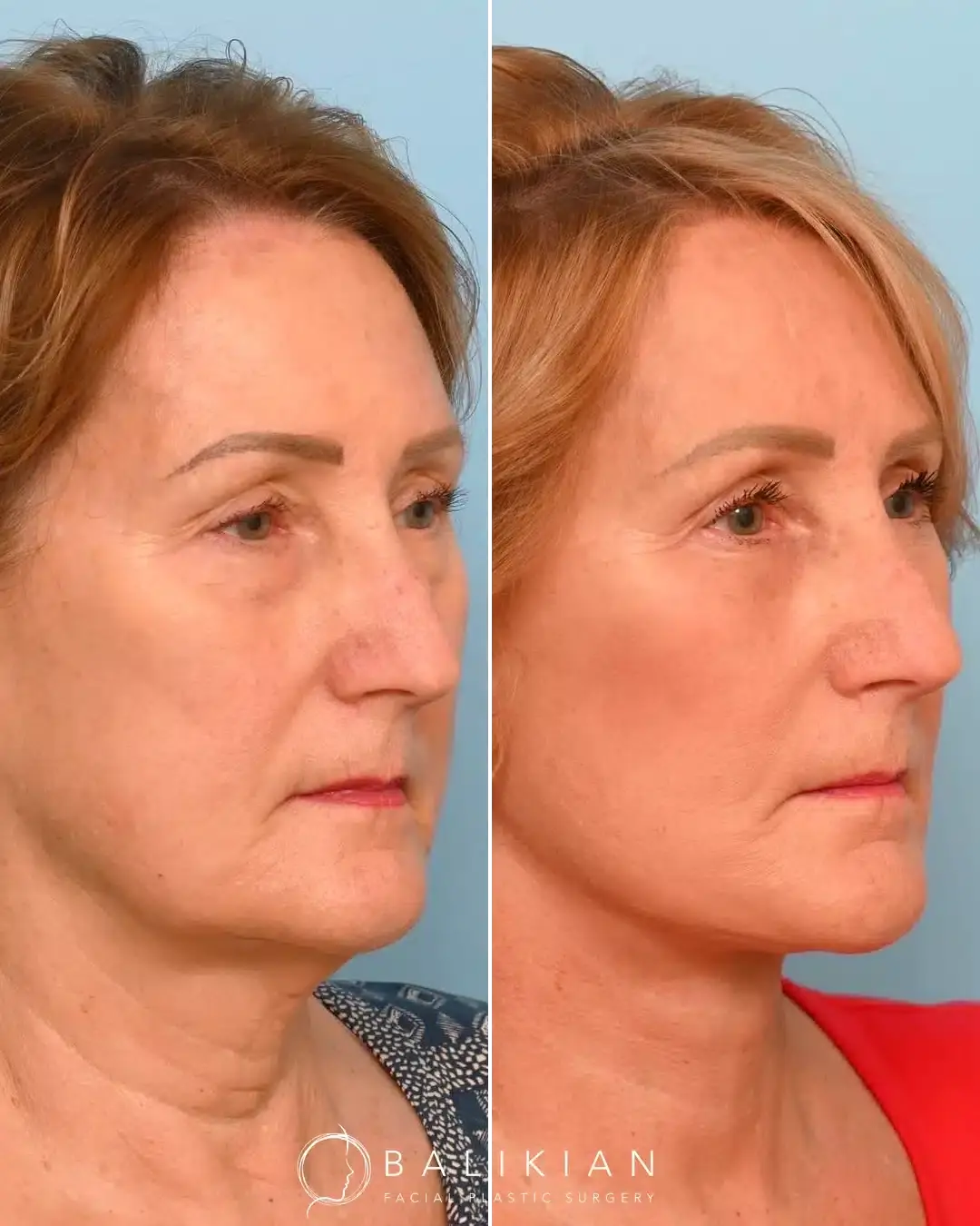 Balikian Facial Plastic Surgery facelift result — Del Mar, CA