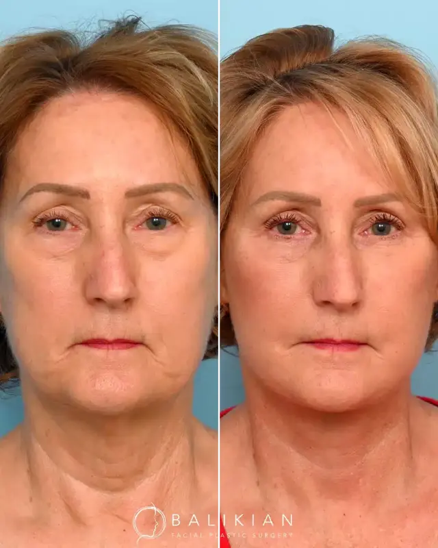 Facelift result at Balikian Facial Plastic Surgery in Del Mar, CA