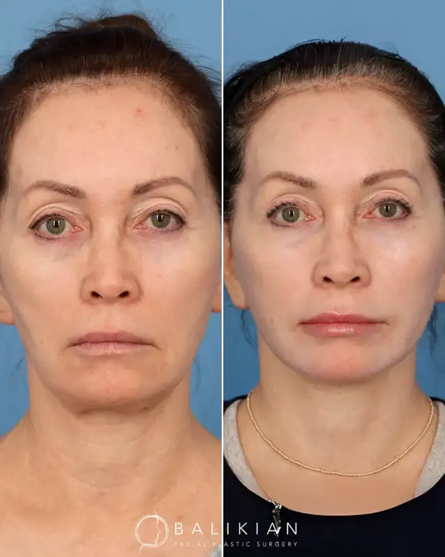 Facelift result at Balikian Facial Plastic Surgery in Del Mar, CA