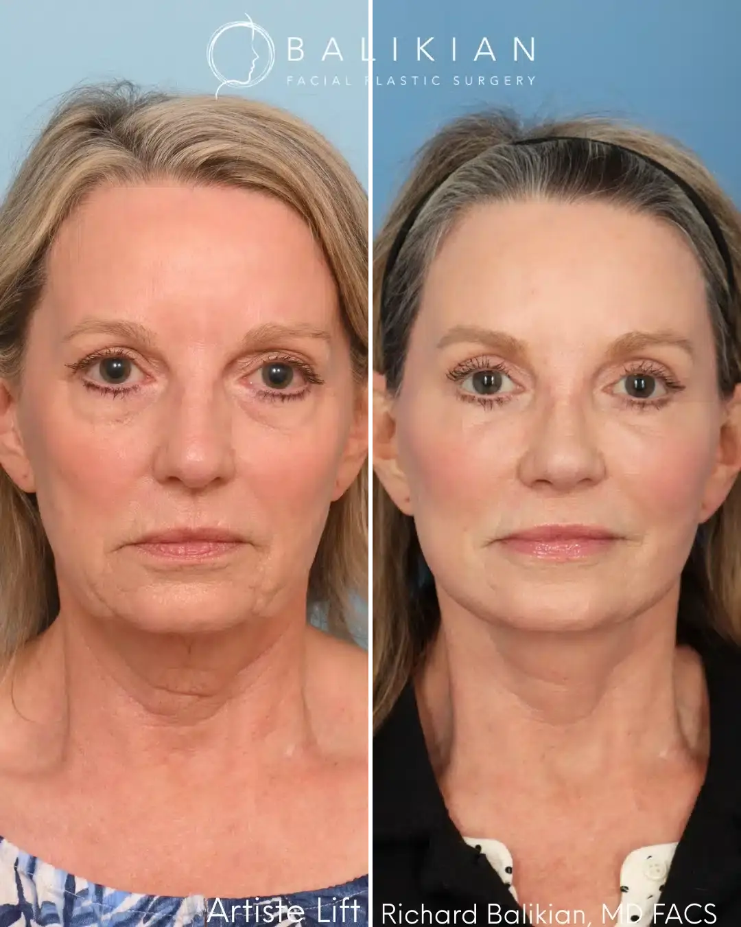 Balikian Facial Plastic Surgery facelift result — Del Mar, CA