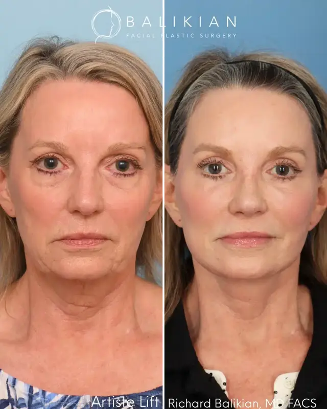 Facelift result at Balikian Facial Plastic Surgery in Del Mar, CA