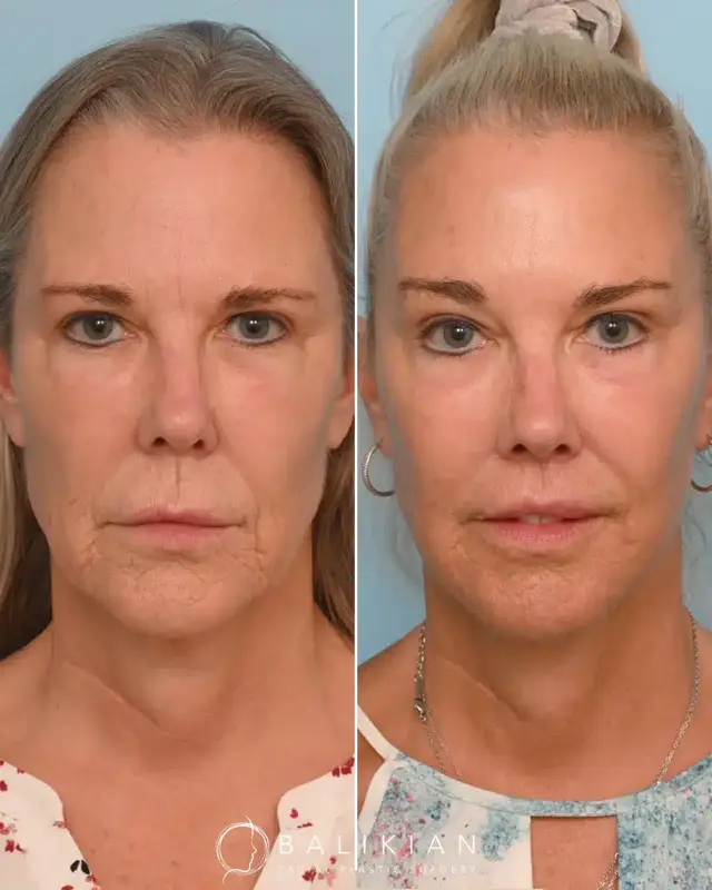 Neck Lift result at Balikian Facial Plastic Surgery in Del Mar, CA