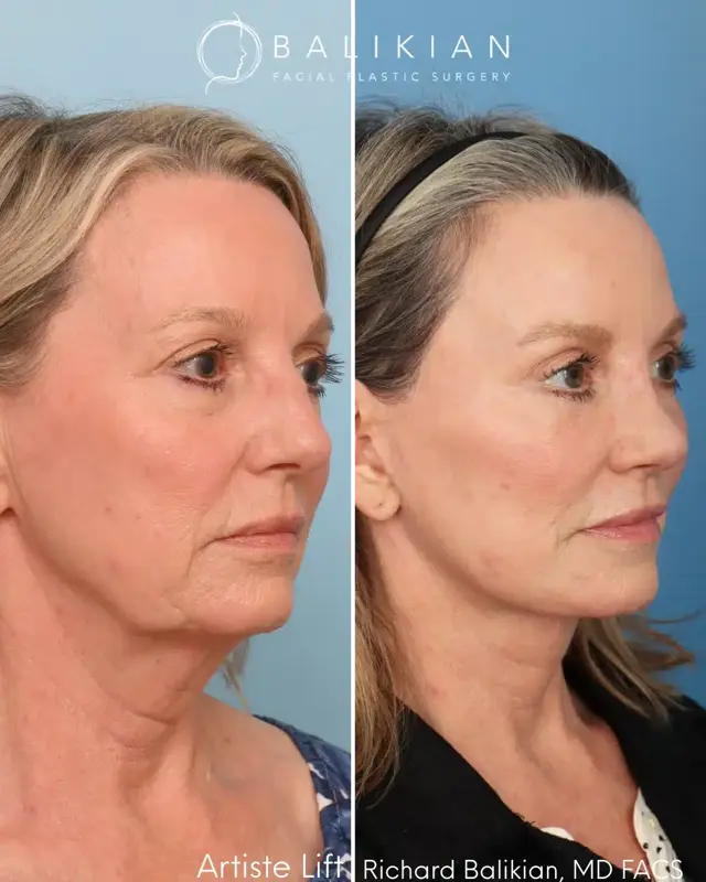 Facelift result at Balikian Facial Plastic Surgery in Del Mar, CA