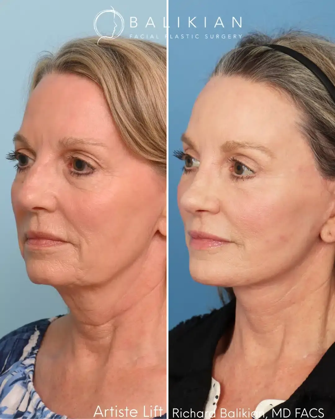 Balikian Facial Plastic Surgery facelift result — Del Mar, CA