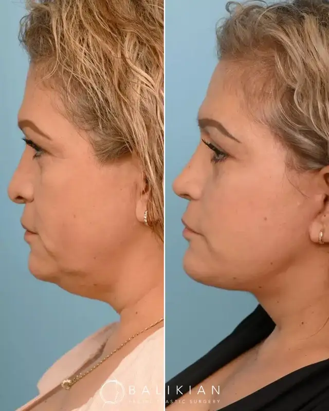 Facelift result at Balikian Facial Plastic Surgery in Del Mar, CA