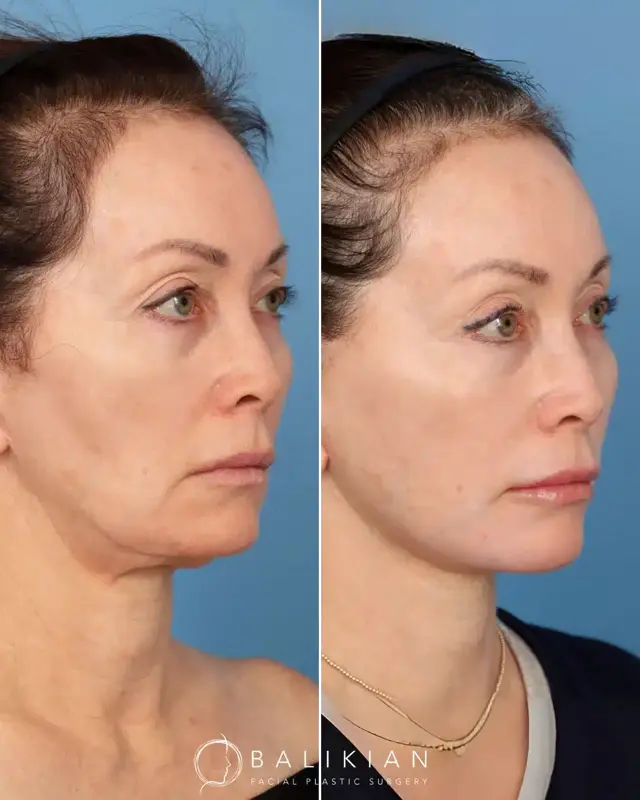 Facelift result at Balikian Facial Plastic Surgery in Del Mar, CA