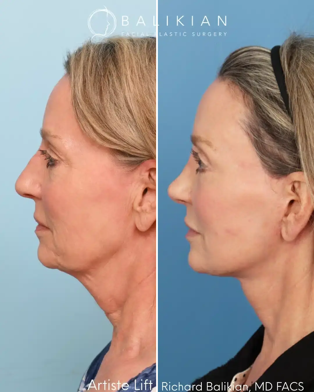 Balikian Facial Plastic Surgery facelift result — Del Mar, CA