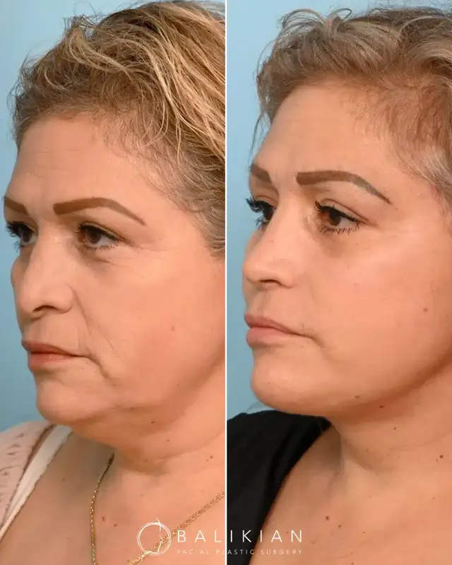 Facelift result at Balikian Facial Plastic Surgery in Del Mar, CA