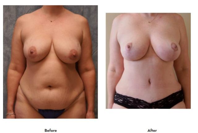Mommy Makeover result at Pasadena Surgeons in Pasadena, CA
